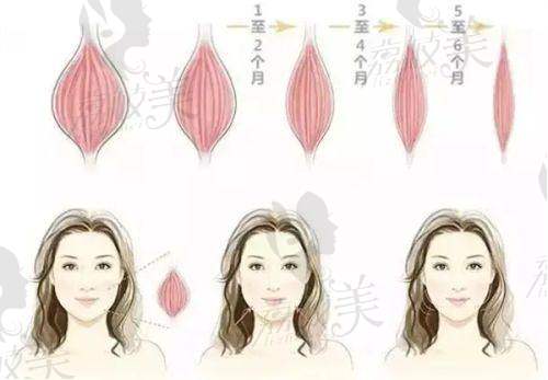 北京漾格医美邢志花瘦脸针价格分阶情况如何？