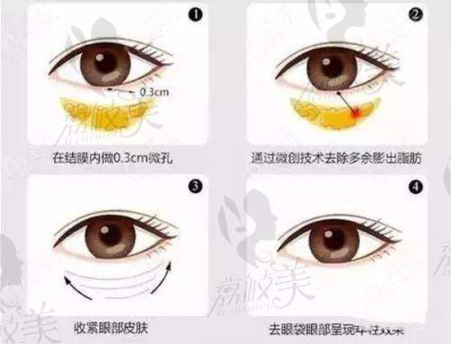 苏州美诗沁去眼袋正规吗？技术与设备优势明显