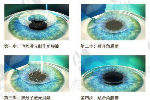 济南华厦眼科半飞秒价格9800元起，享优质服务、先进设备与专业医生团队 