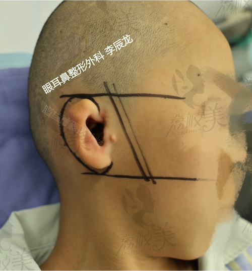 张朝梅耳再造口碑如何？国内排名前三医生，技术高超经验足成效好获赞誉