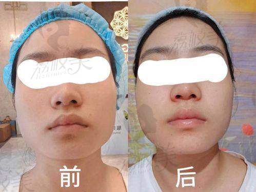 如何预约北京漾格医美邢志花医生的瘦脸针项目？
