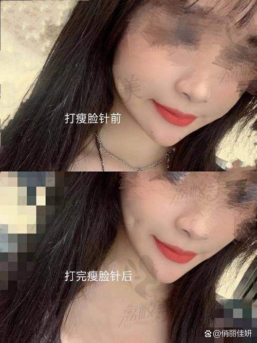北京漾格医美在瘦脸针项目上有哪些优势？