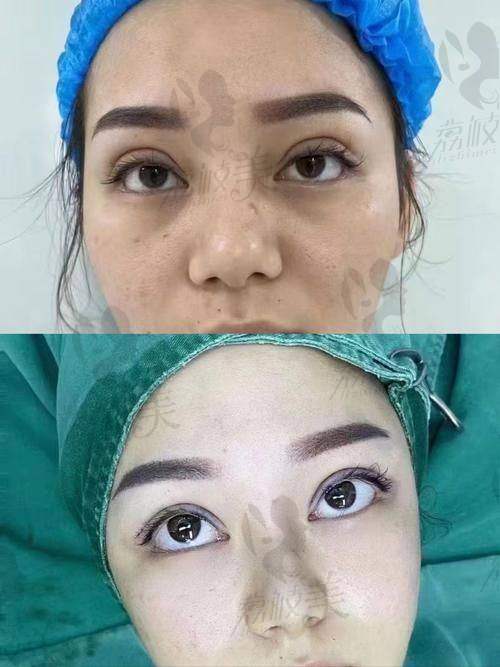 张楚医生双眼皮修复技术亮点：显微级修复+三维动态评估，闭眼无痕是招牌