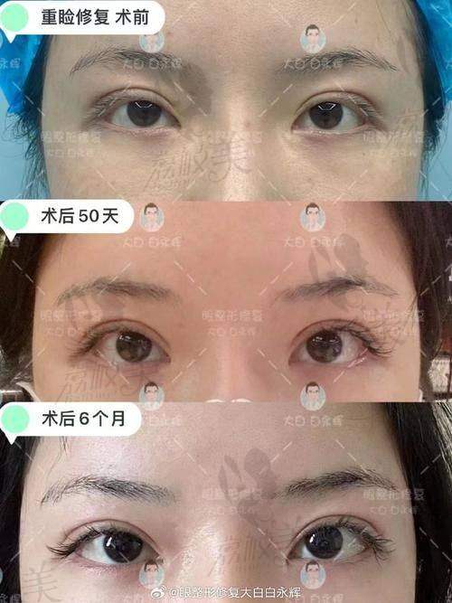 张楚医生修复价格区间为什么在1.8万-4万？性价比如何？