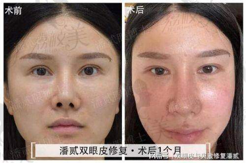 实例数据表现亮眼，关键术后真实口碑好评多：不夸张，术后“闭眼像没动过”