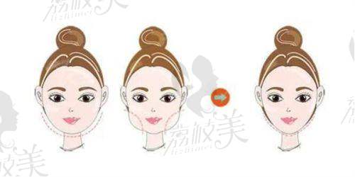 芜湖伊莱美整形曹闪妹综合治疗理念