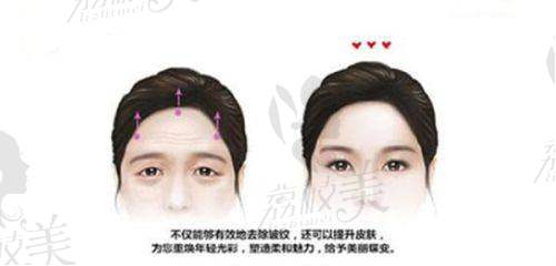 拉皮除皱的费用受哪些因素影响？