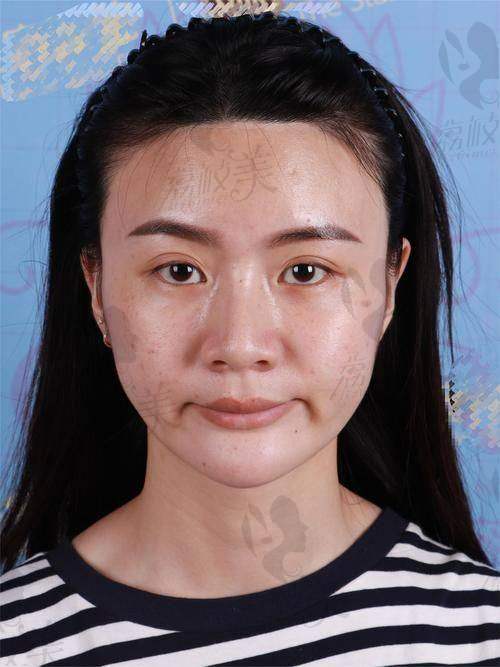 上海袁玉坤医生面部填充：多部位组合能否优惠？