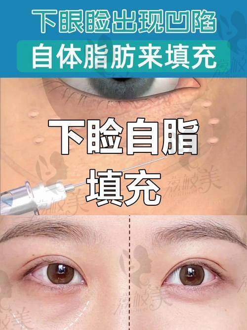 脂肪填充后的真实维持时间有多久？