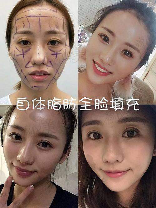 看过实例才有“底”：袁玉坤脂肪填充成效真实反馈