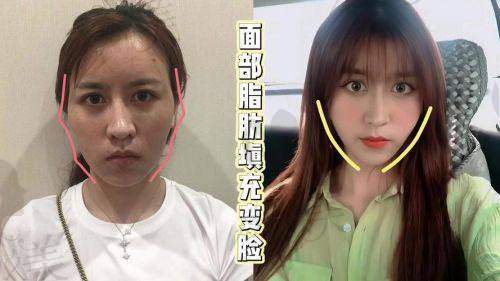 上海美莱袁玉坤医生脂肪填充价格大起底：多少钱起？