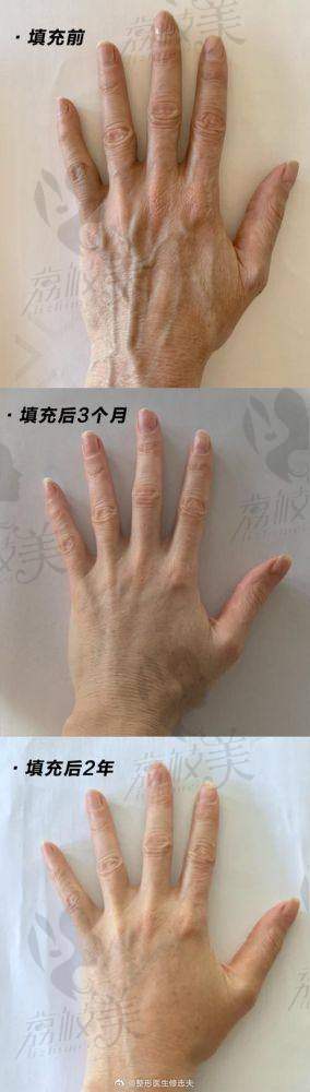 袁玉坤脂肪填充价格透明吗？是否容易被“忽悠多做项目”？