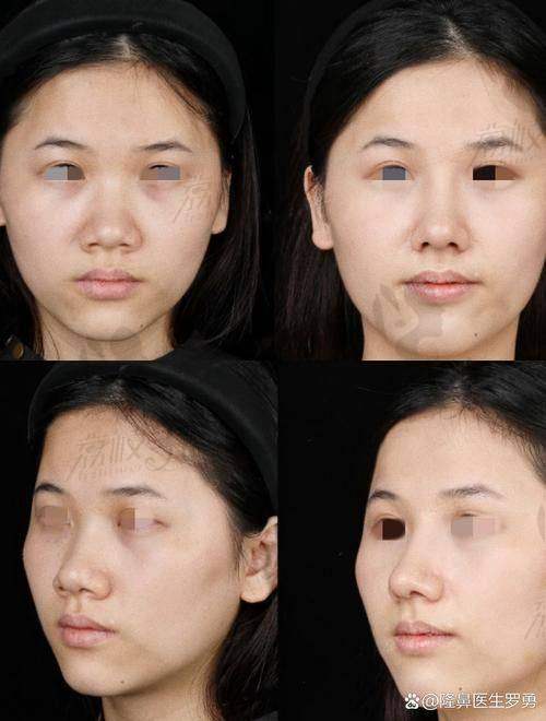 深圳张辉做鼻子到底怎么样啊？赫本骨感鼻综合自然率达98%，0假体穿透及挛缩