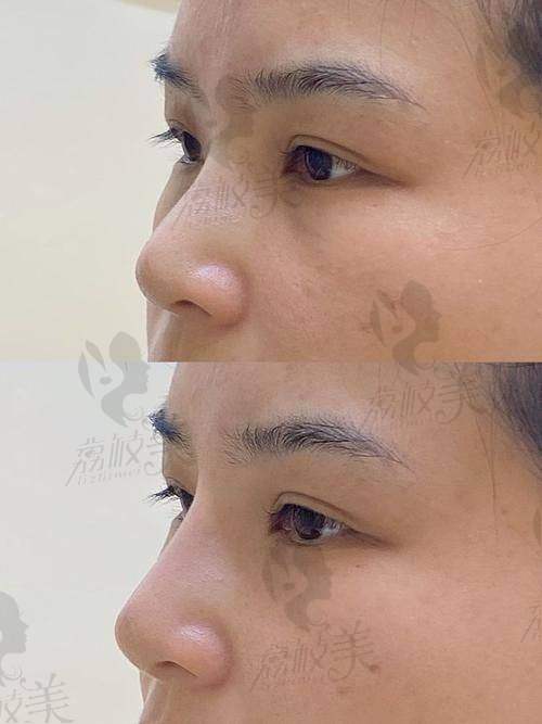张辉医生术后成效真实提醒：做鼻子不是万能的，但合适更重要
