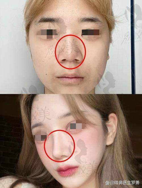 张辉医生患者评价怎么样？“赫本鼻”