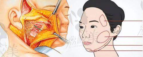 梁伟中医生眼周复位技术全解析：原理更精良，定位更精细