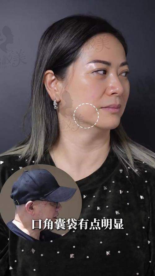 梁伟中眼周筋膜提升有多硬核？从“表面修饰”跃升为“深层加固”