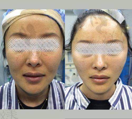 梁伟中眼周复位和眼周筋膜提升是一样吗？手术特点、价格全解析
