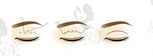 假体隆胸项目价格:多样选择,性价比高