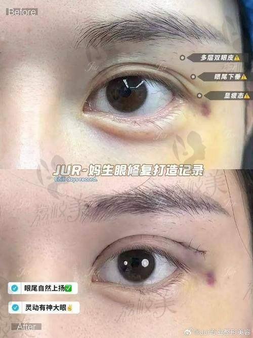 三点式修复手术流程揭秘：小改动也大讲究