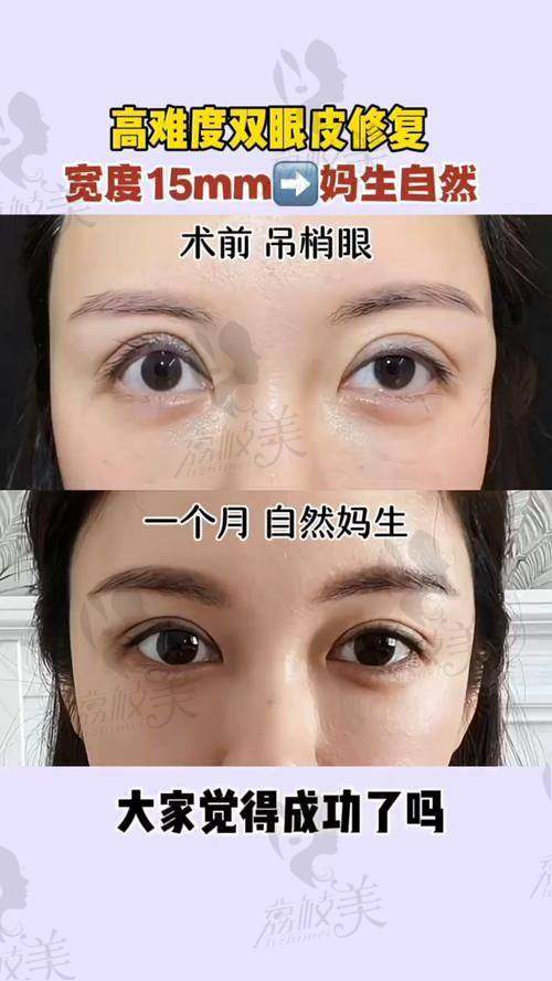 姬东硕注射类项目：玻尿酸提纯技术＋层次注射打造精致五官