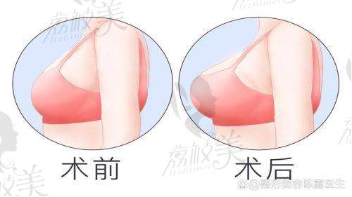 郑州及河南隆胸医院口碑评价