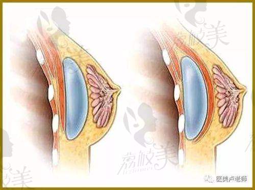 总结郑州及河南隆胸医院优势