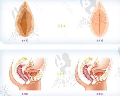 张红歌医生患者评价怎么样？郑州科大医院私密抗衰与修复实例，告诉你真实口碑