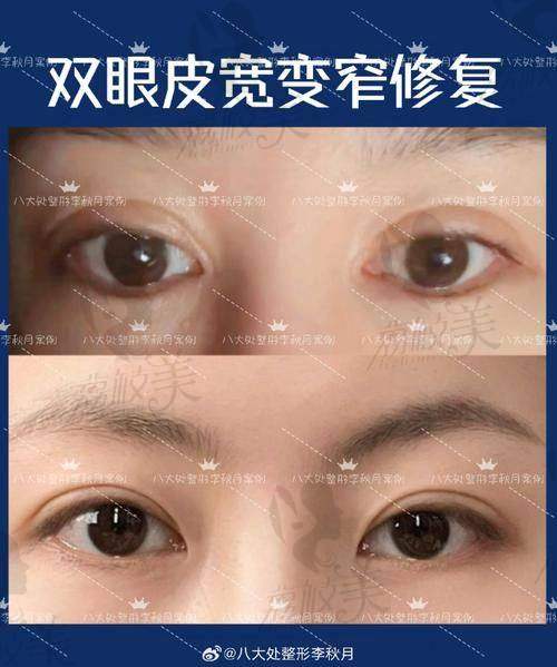 别再被谣言误导，姬东硕三点式技术值得一试