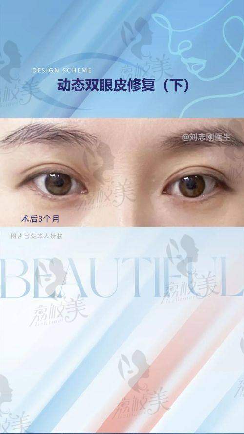 如何预约北京姬东硕医生做双眼皮？这些步骤要记清