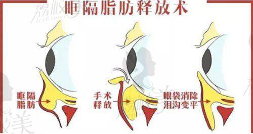 刘辅容双眼皮修复技术怎么样?业内外口碑都说好