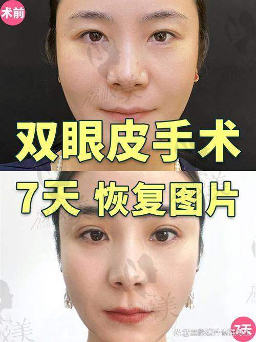 刘辅容双眼皮修复的真实技术优势有哪些?