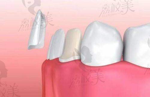 重庆众植博仕口腔肖婷做超薄贴面患者口碑评价