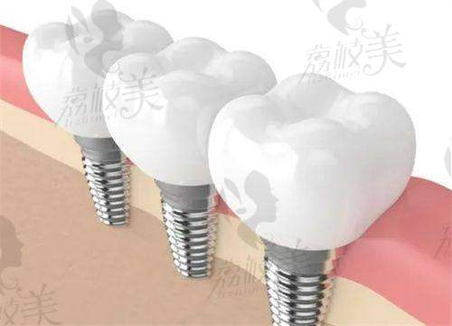 种牙决策不再迷茫,是否选择Neoss这么判断