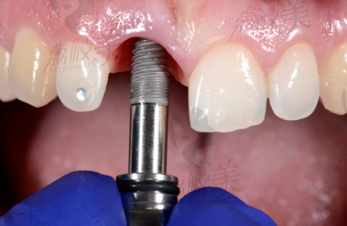 Neoss植体贵在哪里?从亲水表面到设计结构全揭秘