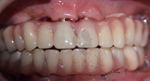 了解Neoss种植体是哪国的?植体价格是多少钱