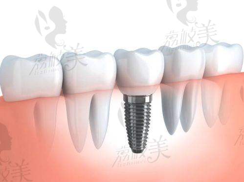 从材料讲出来的“安心感”,Neoss对身体有害吗?