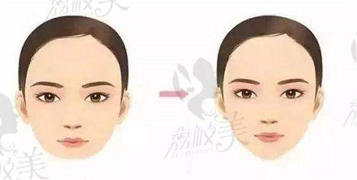 曼托假体的优势