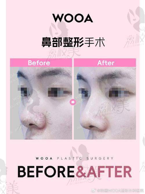 濡白天使针打鼻子成效如何？