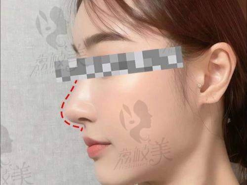 濡白天使针打鼻子多少钱？1.2w起效果自然持久，广州丽合李海航医生亲诊