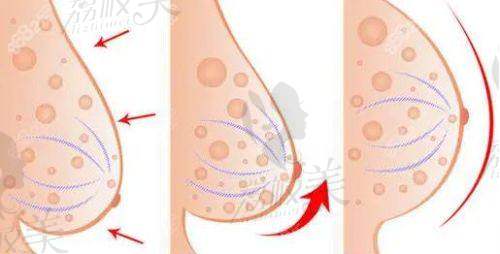 23800元乳房悬吊是怎么做的？看不懂术语也能明白