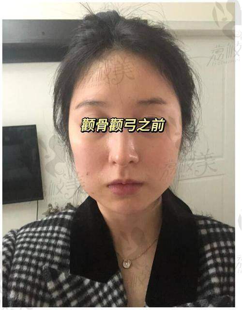 李运峰颧骨内推价格 35800 元+，微创不留疤，脸型柔和显小，上镜超好看！