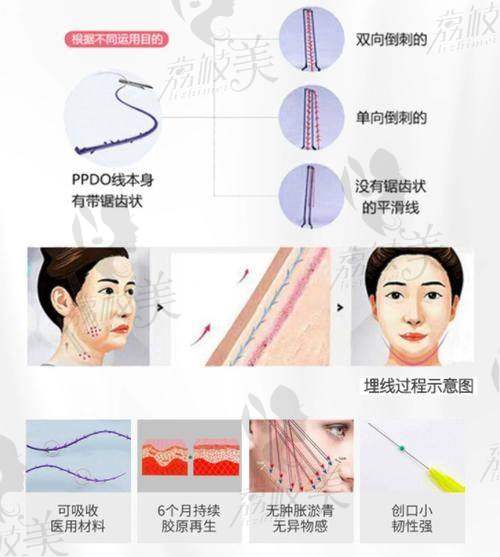 中山贝熙医疗美容国产埋线提升单部位6800元起，紧致抗衰效果显著引关注 