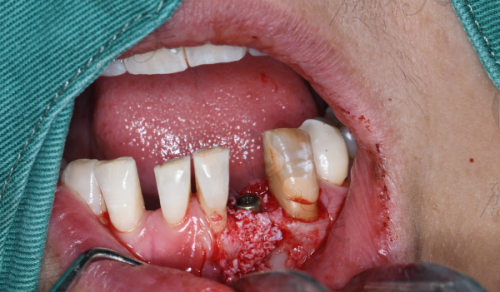 2026年德韩口腔种植牙1200/1380/2000元靠谱吗?来看看法定价目表