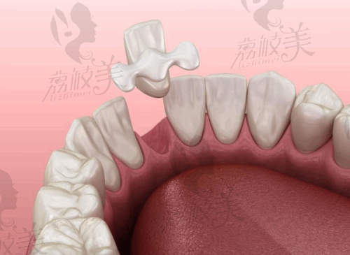 6. 与其他品牌全瓷牙价格对比