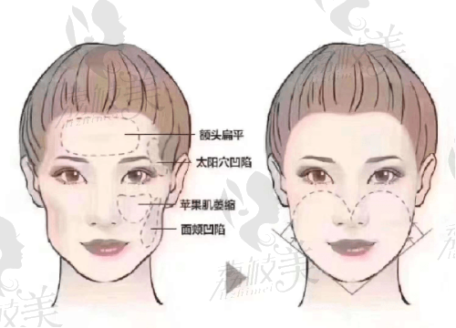 沈阳杏林整形外科医院在线挂号流程公布了吗？3步快速预约张莹莹医生双眼皮手术