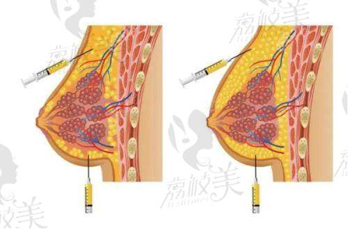 济南美莲整形双D蜜桃丰胸术的成效保护