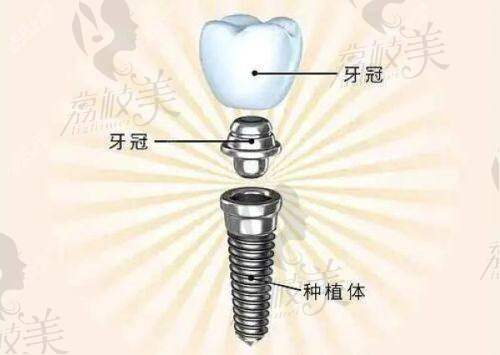 浙医邵逸夫医院牙科中心2025价格表曝光！种植牙4500元起，矫正、贴面收费全公开