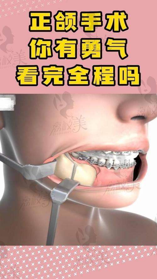 做过正颌手术的真实患者评价来了！