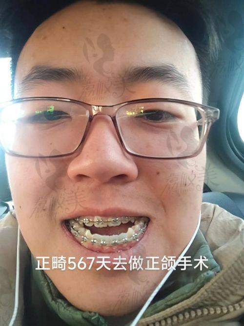 重庆松山正颌手术价格透明吗？具体费用是多少？